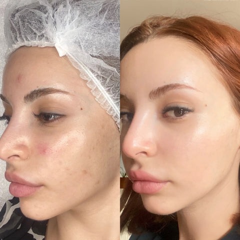 Bio-Collagen Mask